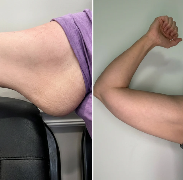 Manchons Raffermissants pour les Bras NOREVYIA™